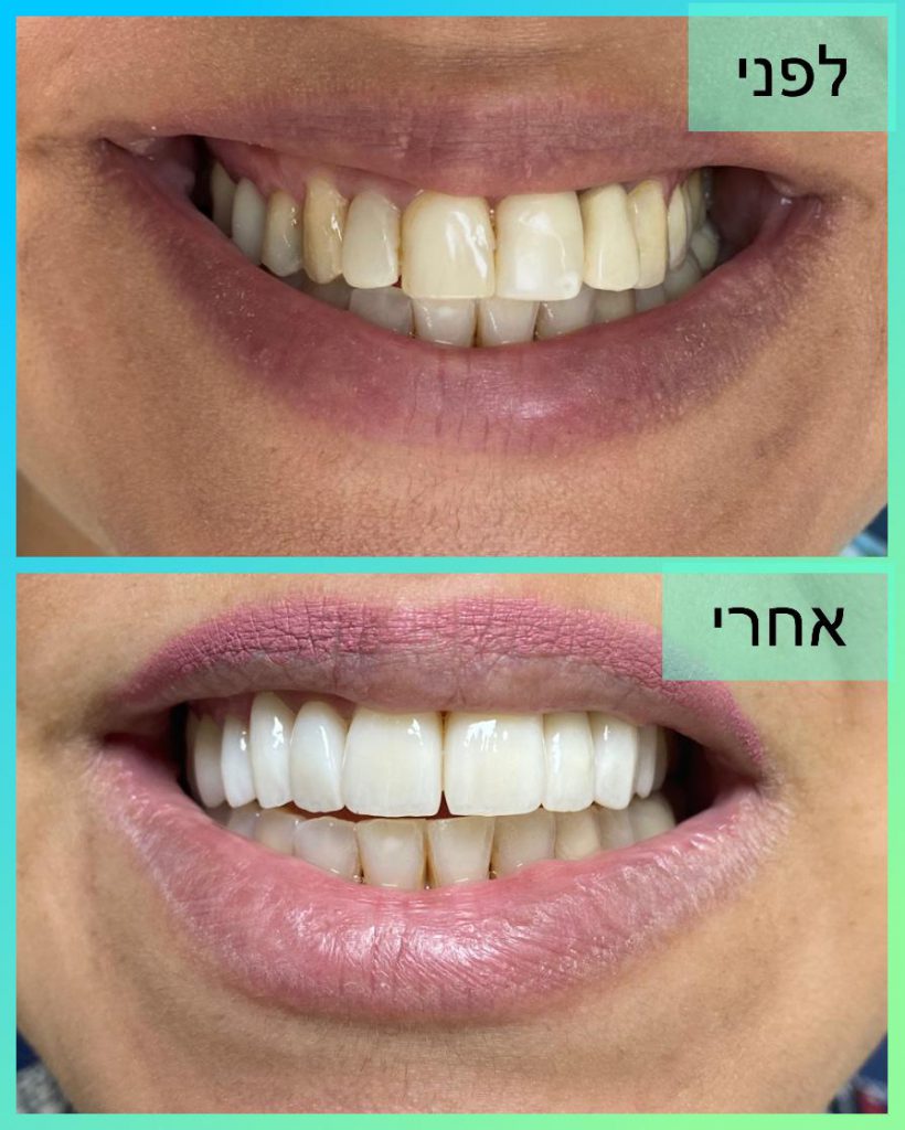 מכבים דנט 1
