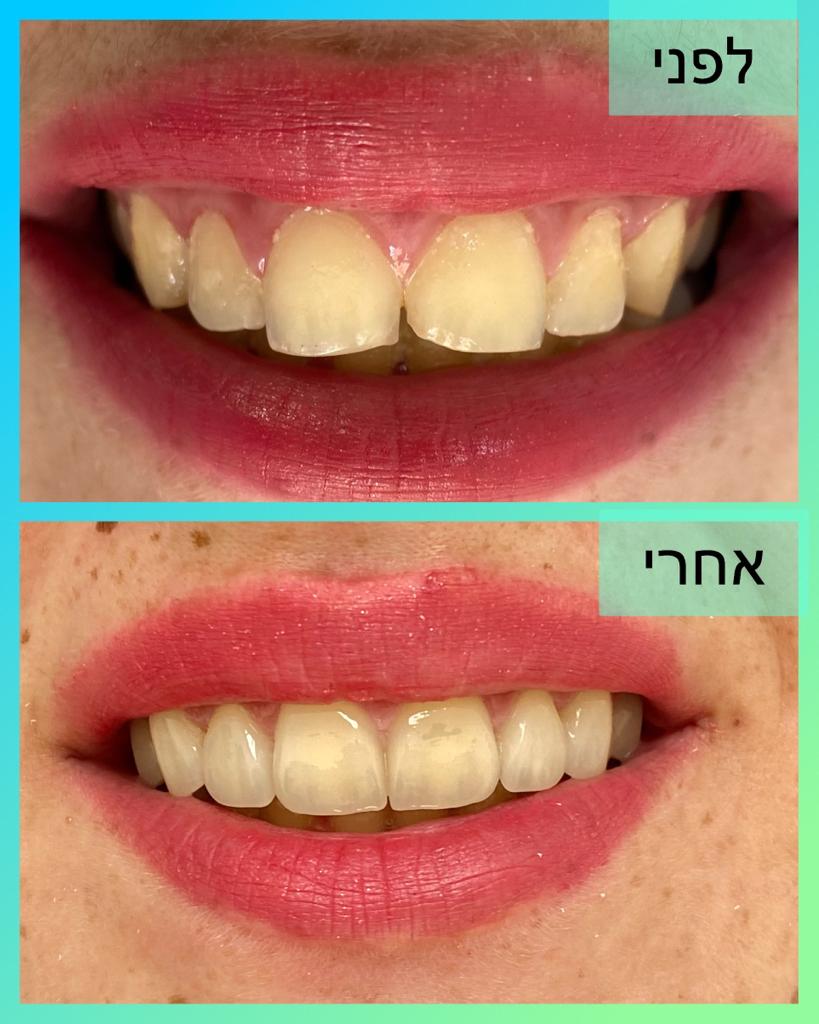 מכבים דנט 2