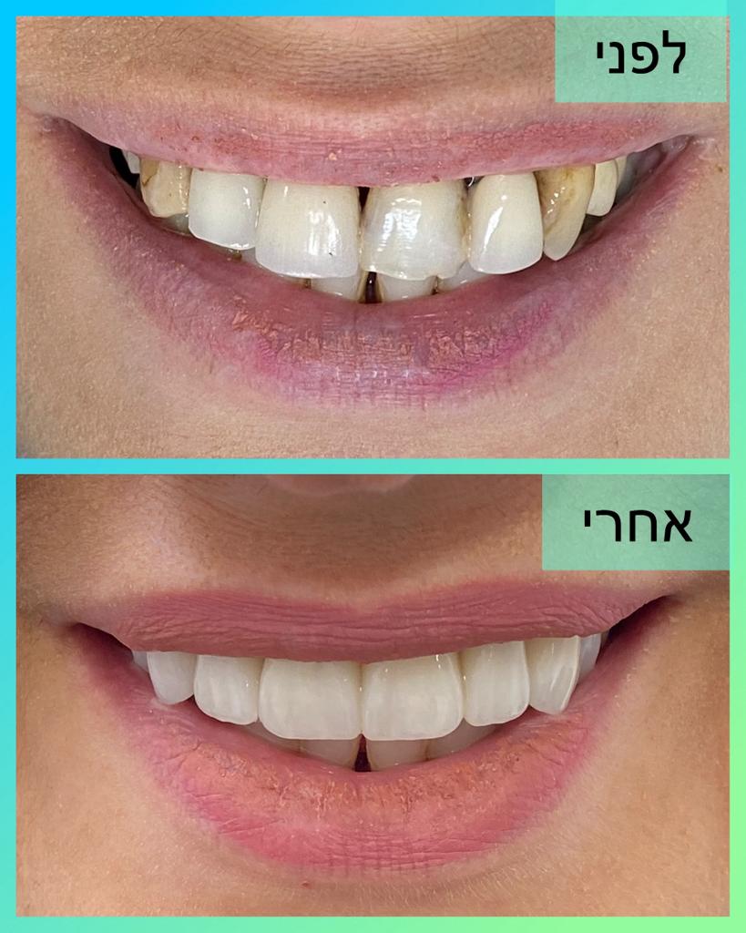 מכבים דנט 3