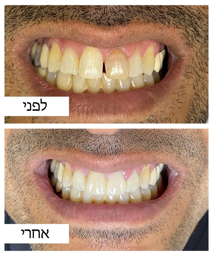 לפני ואחרי 1
