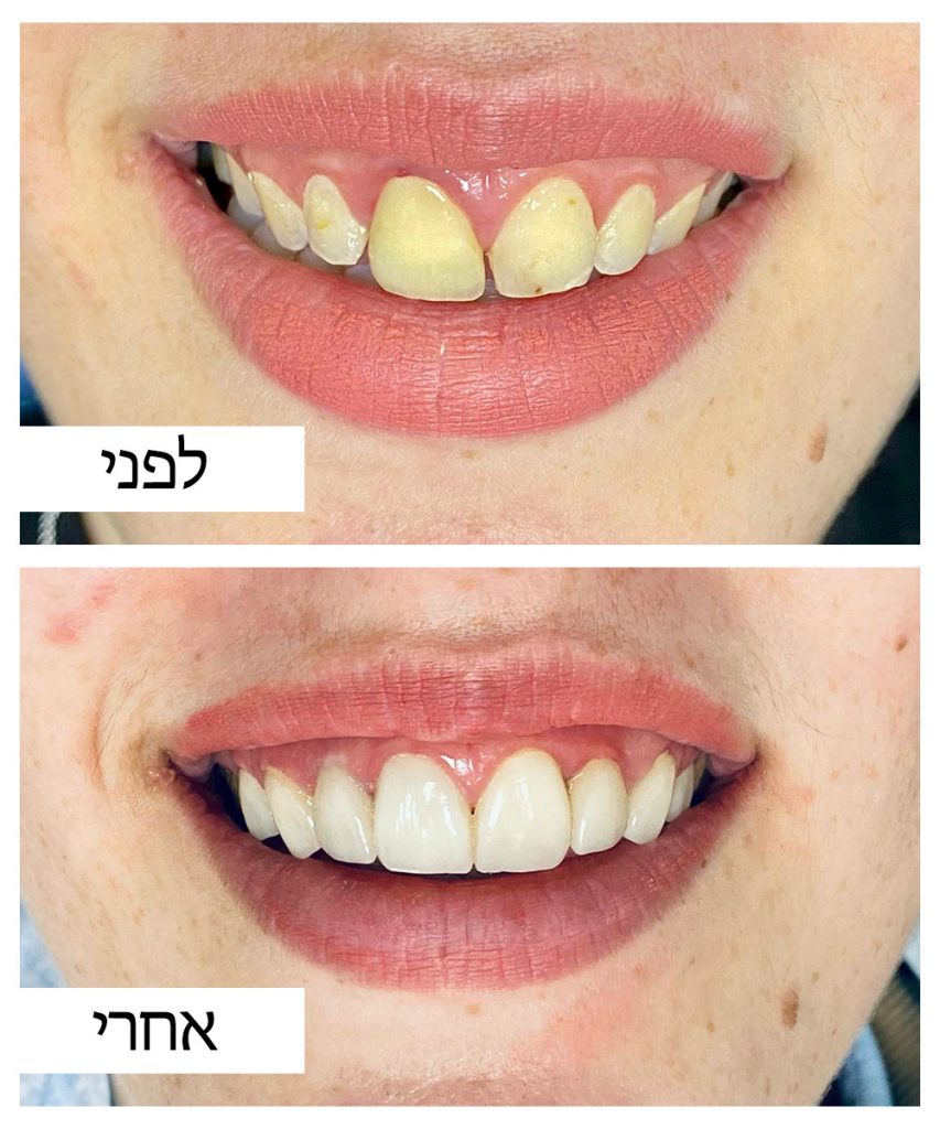 לפני ואחרי 2