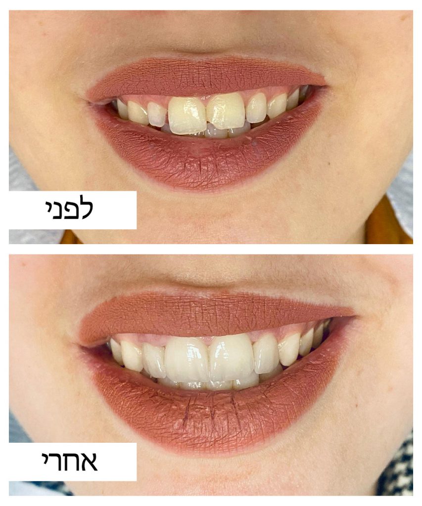 לפני ואחרי